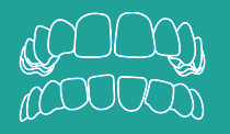 Gapped Teeth
