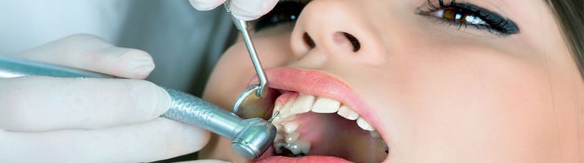 dental filling 840x2351