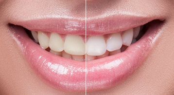 teethwhitening